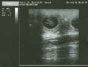 a_Ultraschall_2_3_1